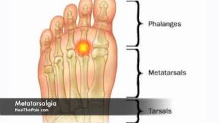 Metatarsalgia Foot Pain Causes Symptoms amp Treatments [upl. by Ahsinev196]