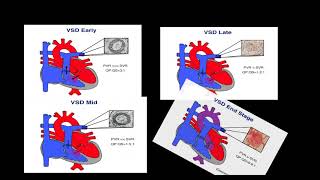 EISENMENGER SYNDROME [upl. by Sanderson676]