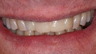 Oque Fazer Caso não Conseguir Adaptar com a Prótese Dentária de Silicone Removível [upl. by Robenia]