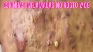 Espinhas Inflamadas no Rosto 09 [upl. by Goldin468]