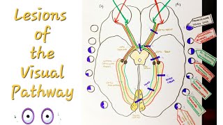 Lesions of the Visual Pathway  Optic Nerve and pathway lesions [upl. by Neirrad58]