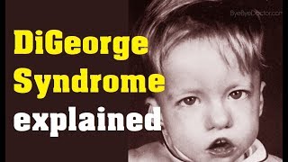 What is DiGeorge Syndrome  Cause and Treatment [upl. by Yelraf]