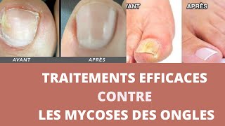 Comment soigner une mycose des ongles [upl. by Flossi]