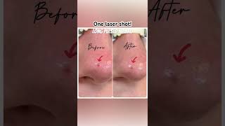 Laser Ndyag for vascular treatment cherryangioama nose ndyaglaser olimpiacarmen spiderveins [upl. by Arhas]