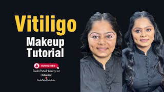 vitiligo skin makeup tutorials [upl. by Oicnanev]