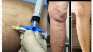 ESCLEROTERAPIA TRATAMENTO DE VARIZES COM ESPUMA DENSA [upl. by Mcdade975]