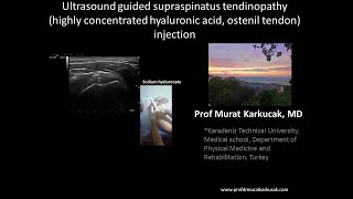 Ultrasound guided supraspinatus tendinopathy  hyaluronic acid ostenil tendon injection [upl. by Just]