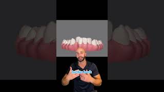 Invisalign Before and After Timelapse 2023 [upl. by Specht192]