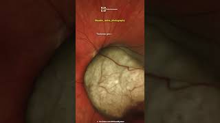 Choroidal Melanoma [upl. by Dougall]