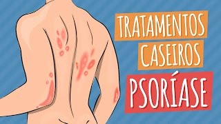 PSORÍASE  Tratamentos Caseiros [upl. by Pubilis920]