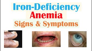 IronDeficiency Anemia Signs amp Symptoms ex Fatigue “Spoon Nails” Cracked Lips [upl. by Irami]