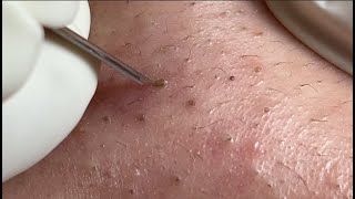 Acne Treatment Huong Da Nang membership 006   2023 [upl. by Kcirddec]