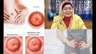 Nabothian cyst l নেবোথিয়ান সিস্ট [upl. by Retsek]