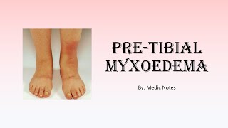 Pathophysiology of pretibial myxoedema [upl. by Gelasias]