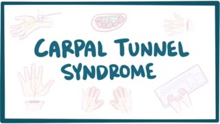 Carpal tunnel syndrome  causes symptoms diagnosis treatment amp pathology [upl. by Hentrich]