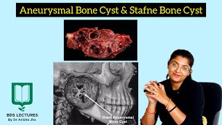 Aneurysmal Bone Cyst  Stafne Bone Cyst  Lecture 18  Oral Pathology [upl. by Penelopa]