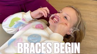 GETTING STARTED WITH BRACES AT AGE 8  SHORTEN BRACES TIME  MOUTH EXPANDER  TOO YOUNG FOR BRACES [upl. by Rawden88]