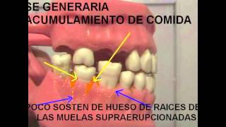 PERDIDA DE MOLAR CONSECUENCIAS [upl. by Ulises]