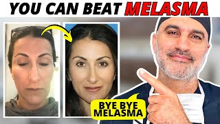 How Dr Amir Karam treated his wifes Melasma AT HOME Step by Step [upl. by Mraz]