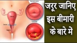 गर्भाशय ग्रीवा शोथ │ यौन संक्रमण रोग │ Cervicitis Symptoms amp Causes [upl. by Melamie]