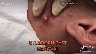 💥INFLAMMED STUBBORN EPIDERMOID CYST REMOVAL 💥 [upl. by Cheng]