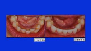 Porcelain Veneers Can Be Instant Orthodontics La Mesa Cosmetic Dentist Dr Jeff Gray [upl. by Rankin]