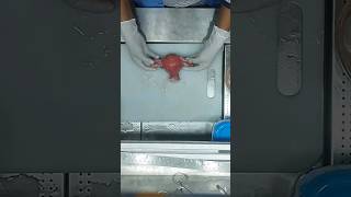 Fibroid utetus specimen😱 specimen newborn uterusproblem cutebaby museum cancer histo patho [upl. by Arri]