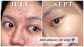 Rekomendasi Skincare utk Jerawat kombinasi berminyak [upl. by Macdonell]