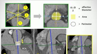 Patient selection for TAVI patient risk profile amp anatomical selection criteria [upl. by Hermia]