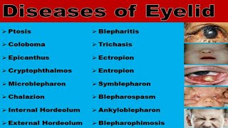 Diseases of Eyelid [upl. by Aerbma437]