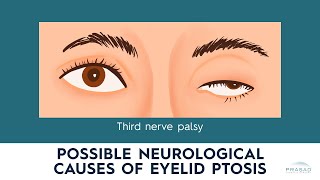 Neurological Causes of Ptosis Myasthenia Gravis Horners Syndrome and Third Nerve Palsy [upl. by Otxis]