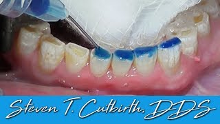 Bonding Worn Anterior Teeth  Dental Minute with Dr Steven T Cutbirth DDS [upl. by Nhor137]