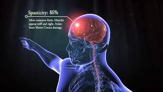 Types of cerebral palsy [upl. by Annia749]