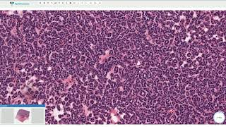 Metanephric Adenoma  Histopathology [upl. by Adnal]