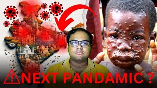 NEXT PANDAMIC Monkey Pox Signs amp Symptoms monkeypox mpox reetmukherjee [upl. by Eicul]