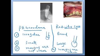 Radicular cyst Concepts Radiographic Features [upl. by Raffaj949]