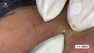 Big Cystic Acne Blackheads Extraction Blackheads amp Milia Whiteheads Removal Pimple Popping [upl. by Yenahs]