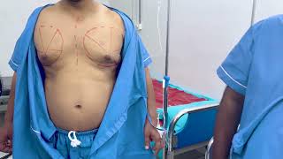 Gynecomastia Surgery Marking in Bangladesh by Dr Sharif [upl. by Brenan]