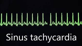 Cardiovascular System 8 Normal and abnormal heart rhythms [upl. by Jacey]