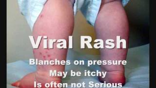 How To Check Meningitis Rash [upl. by Diba]