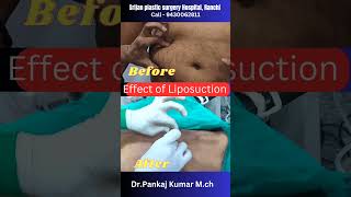 Result of laser liposuction to Remove body fat laser liposuction shorts liposuction [upl. by Elletnahs]