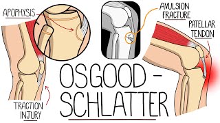 Osgood Schlatter Disease Made Easy Tibial Tubercle Apophysitis [upl. by Irvine]