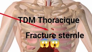 SCANNER THORACIQUE Fracture oblique déplacée sternale [upl. by Fihsak]