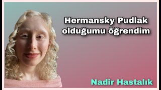 Hermansky Pudlak Sendrom Tip 1 Olduğumu Öğrendim  Hermansky Pudlak Syndrome￼ albinism HPS [upl. by Rennob420]