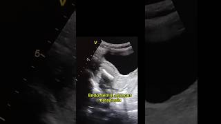 Endometrial osseous metaplasia in ultrasound [upl. by Rhea364]