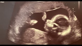 Anomaly Scan Full Video  Full Anatomy Scan at 21 Weeks [upl. by Yeaton533]