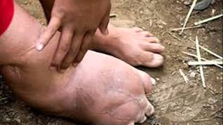 The worms inflating your limbs The battle to eliminate elephantiasis [upl. by Reisfield976]