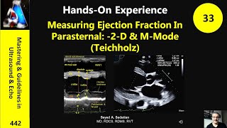 Measuring Ejection Fraction In Parasternal 2D amp MMode Teichholz [upl. by Nnahaid]