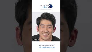 Denture replaced with All On 4 Plus® Dental Implants allon4dentalimplants dentist smile [upl. by Clementine222]