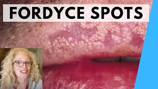 SYRINGOMA VS FORDYCE SPOTS  NATURAL REMEDIES [upl. by Havelock]